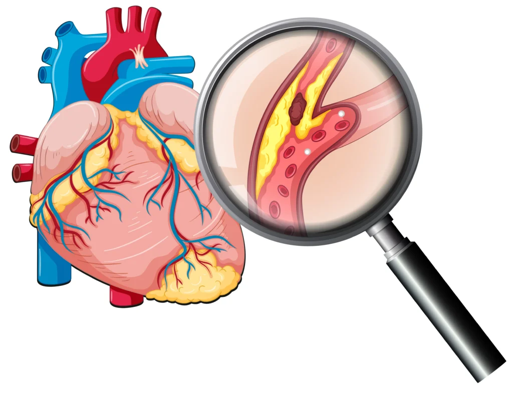 plaque in arteries