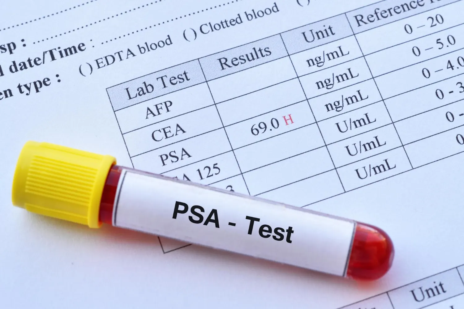 PSA test